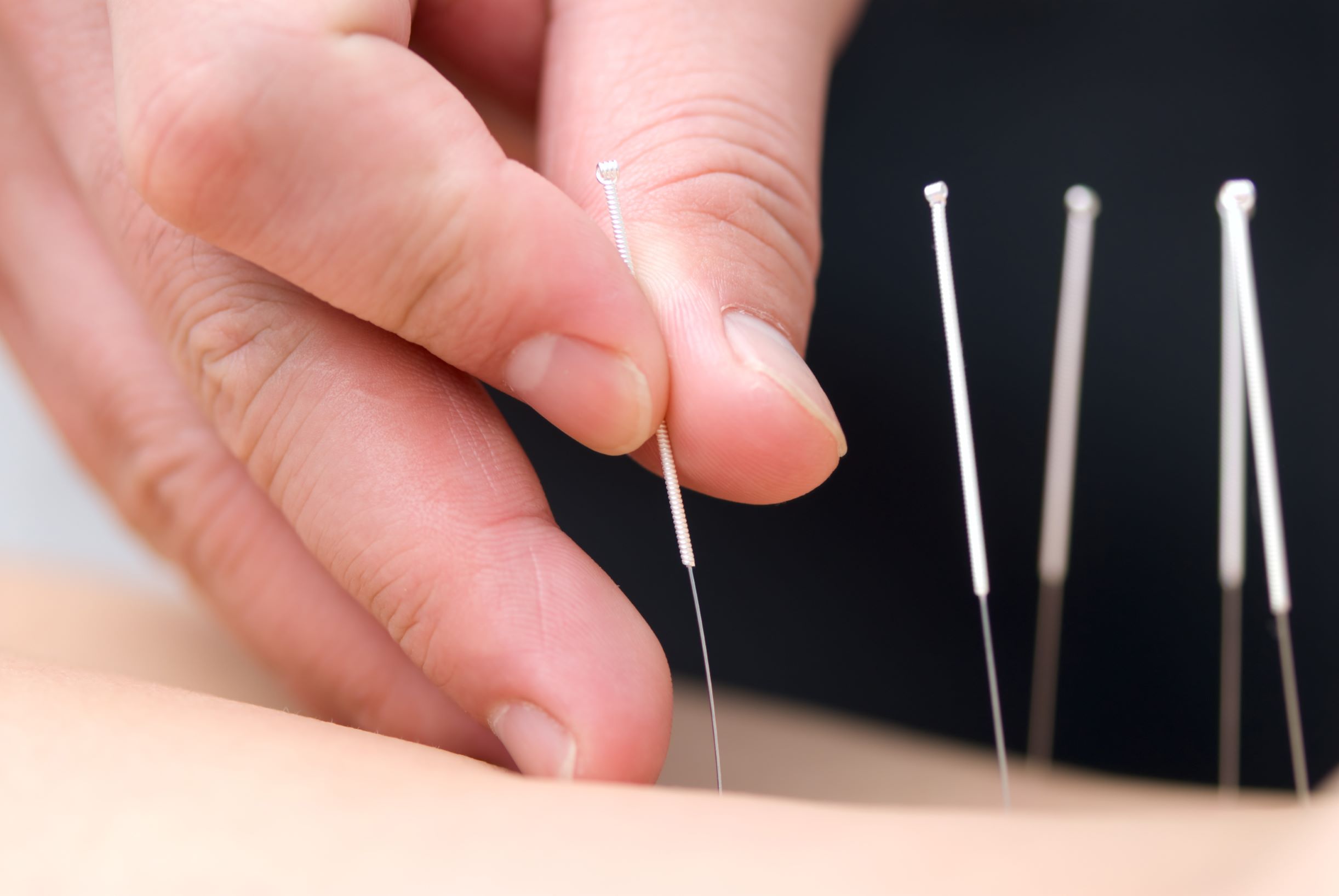 Acupuncture Program