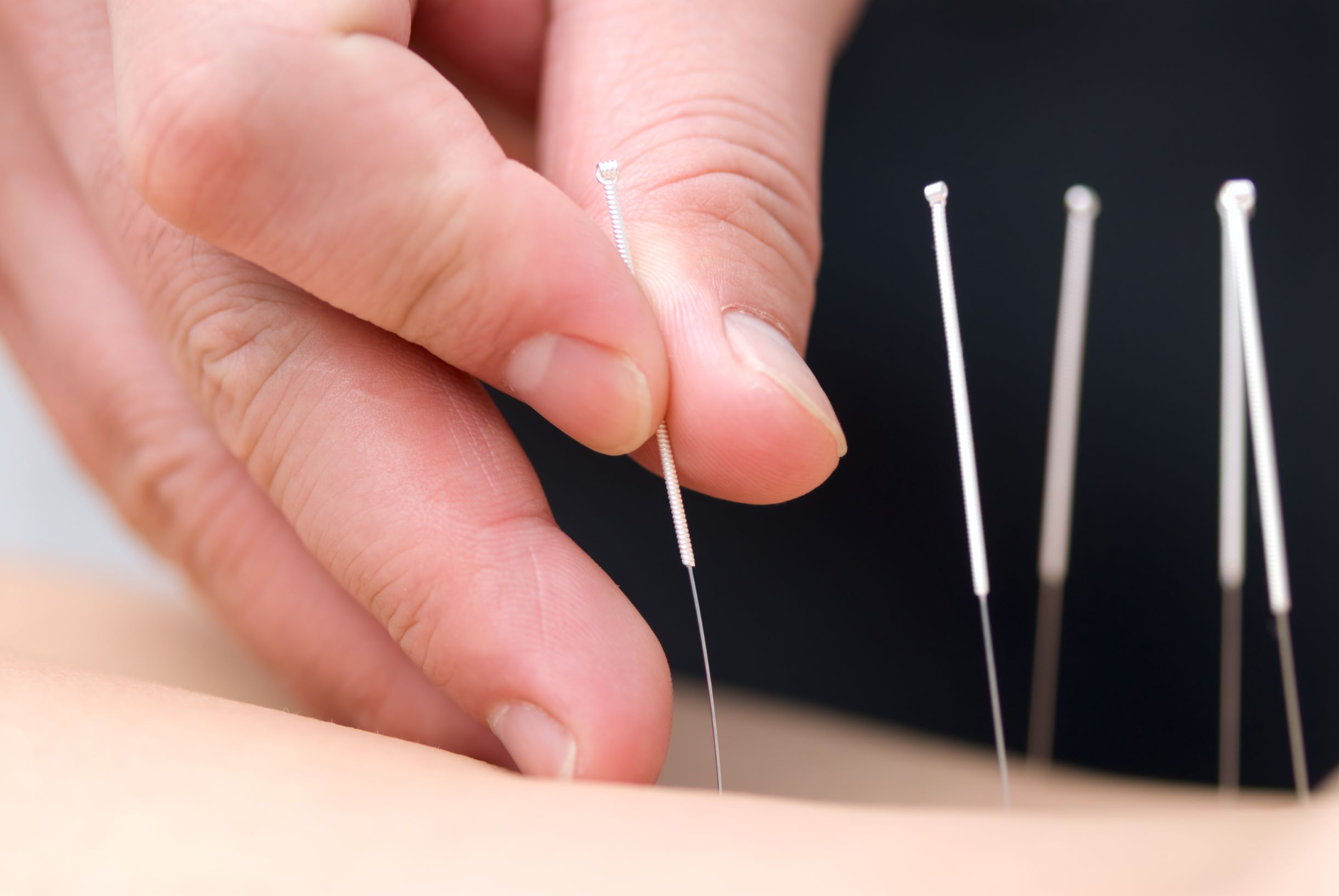 photo of acupuncture needles