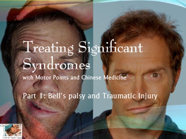 Part one Bell's Palsy